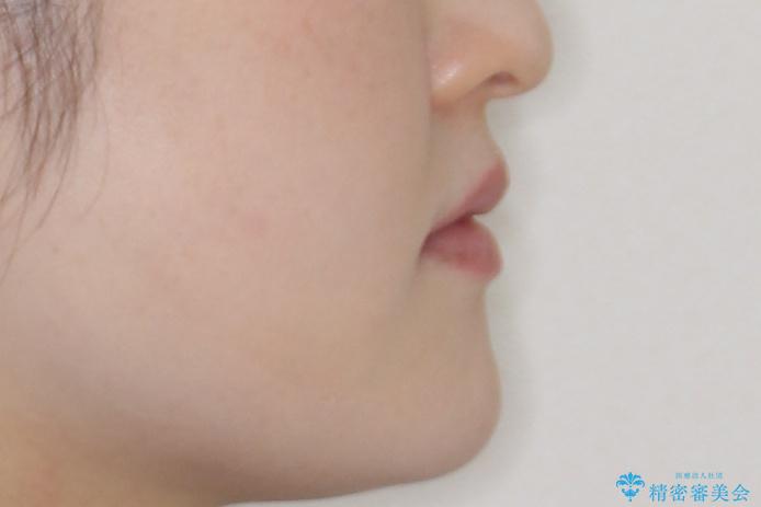 飛び出した八重歯が気になる!非抜歯でマウスピース(インビザライン)による治療症例の治療後(顔貌)