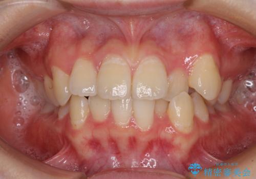 【モニター】八重歯と前歯のクロスバイト ワイヤーを併用しインビザラインで矯正治療の症例 治療前