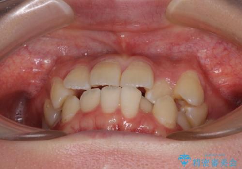 【モニター】八重歯と前歯のクロスバイト ワイヤーを併用しインビザラインで矯正治療の治療前