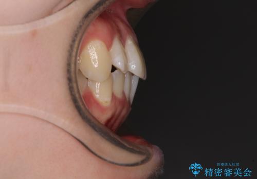 【モニター】八重歯と前歯のクロスバイト ワイヤーを併用しインビザラインで矯正治療の治療前