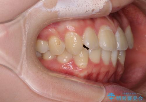 【モニター】八重歯と前歯のクロスバイト ワイヤーを併用しインビザラインで矯正治療の治療前