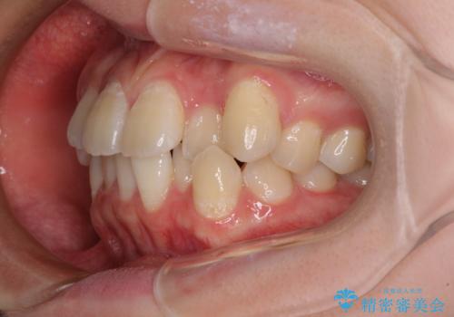 【モニター】八重歯と前歯のクロスバイト　ワイヤーを併用しインビザラインで矯正治療の治療前