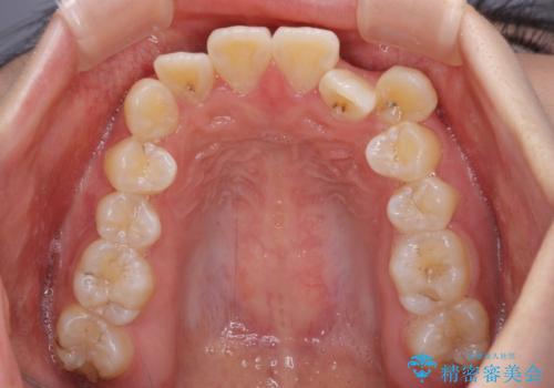 【モニター】八重歯と前歯のクロスバイト　ワイヤーを併用しインビザラインで矯正治療の治療前