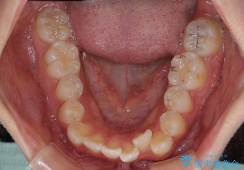 【モニター】八重歯と前歯のクロスバイト ワイヤーを併用しインビザラインで矯正治療の治療前