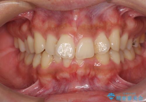 前歯のデコボコをスッキリ改善　インビザライン矯正の症例 治療前