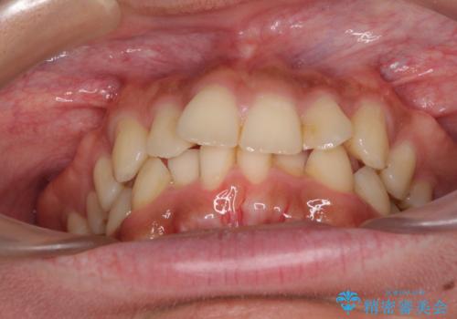 前歯のデコボコをスッキリ改善 インビザライン矯正の治療前