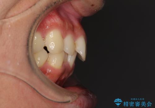 前歯のデコボコをスッキリ改善 インビザライン矯正の治療前