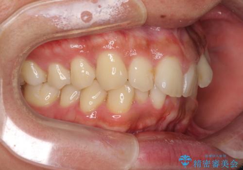 前歯のデコボコをスッキリ改善 インビザライン矯正の治療前
