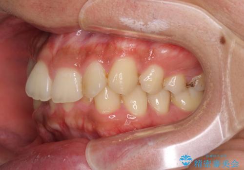 前歯のデコボコをスッキリ改善 インビザライン矯正の治療前