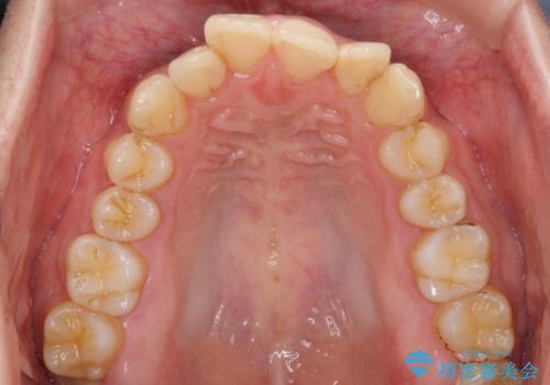 前歯のデコボコをスッキリ改善 インビザライン矯正の治療前