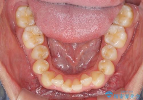 前歯のデコボコをスッキリ改善 インビザライン矯正の治療前