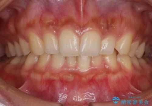 【非抜歯】狭い歯列を改善 ガタつきを治すの症例 治療前