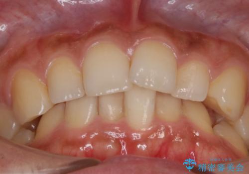 【非抜歯】狭い歯列を改善 ガタつきを治すの治療前