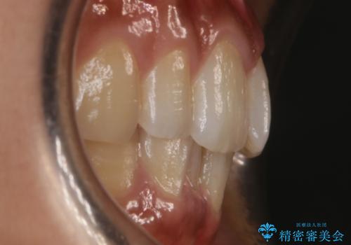 【非抜歯】狭い歯列を改善 ガタつきを治すの治療前