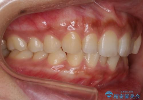 【非抜歯】狭い歯列を改善 ガタつきを治すの治療前