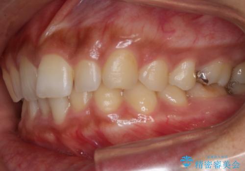 【非抜歯】狭い歯列を改善 ガタつきを治すの治療前