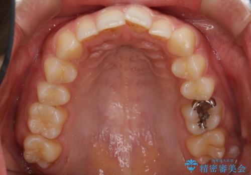 【非抜歯】狭い歯列を改善 ガタつきを治すの治療前