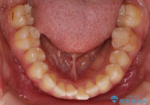 【非抜歯】狭い歯列を改善 ガタつきを治すの治療前