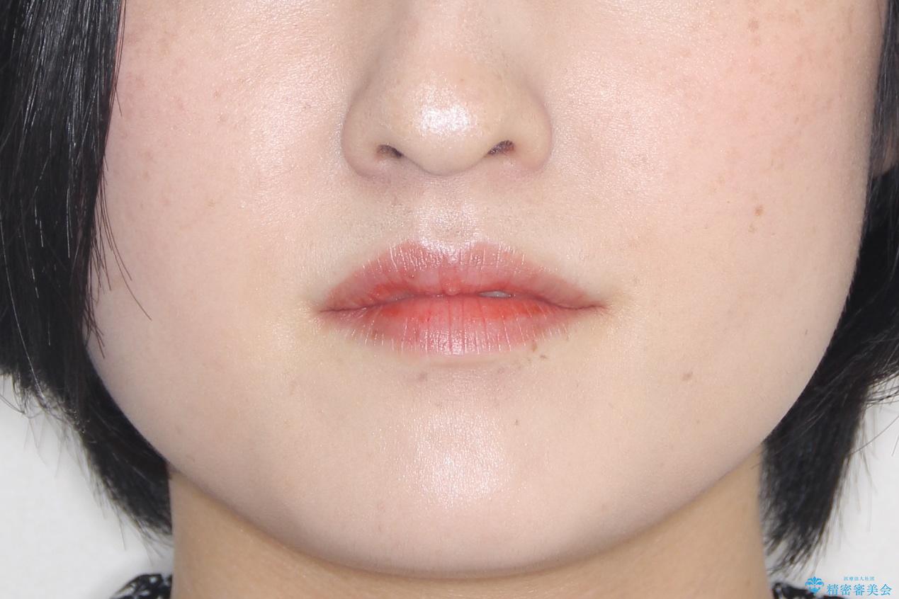 飛び出した八重歯が気になる!非抜歯でマウスピース(インビザライン)による治療症例の治療前(顔貌)