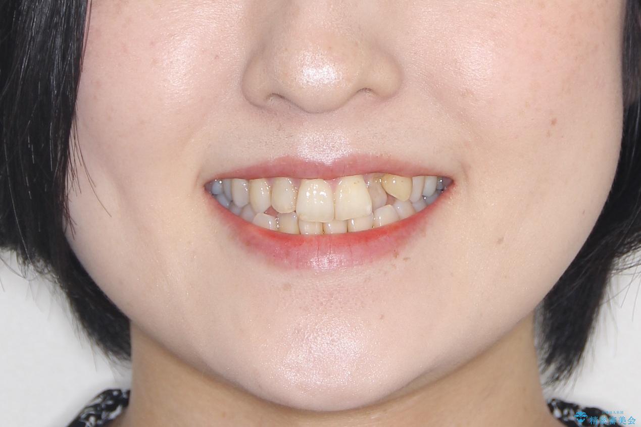飛び出した八重歯が気になる!非抜歯でマウスピース(インビザライン)による治療症例の治療前(顔貌)