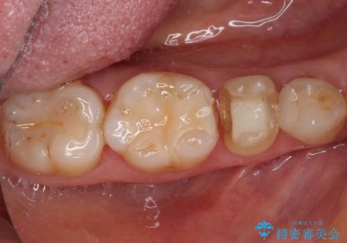以前治療した詰め物が欠けた オールセラミッククラウンによる補綴の治療前