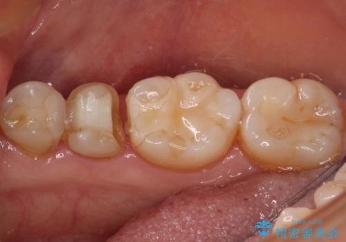 以前治療した詰め物が欠けた オールセラミッククラウンによる補綴の治療前