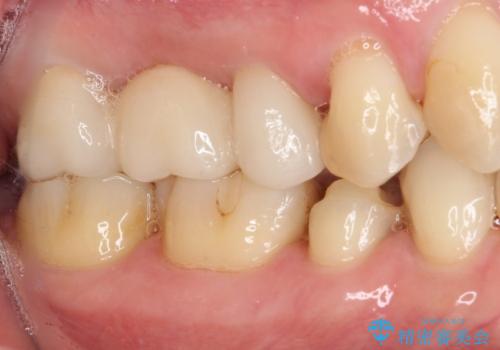 以前治療した詰め物が欠けた オールセラミッククラウンによる補綴の治療前