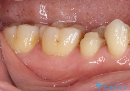 以前治療した詰め物が欠けた オールセラミッククラウンによる補綴の治療前