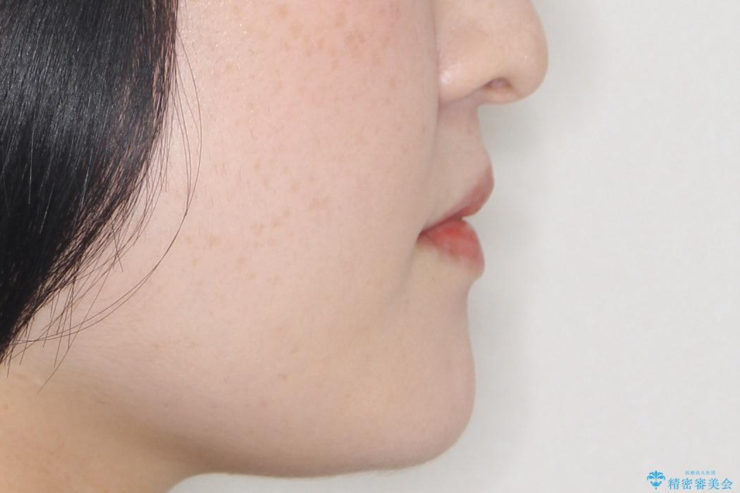 飛び出した八重歯が気になる!非抜歯でマウスピース(インビザライン)による治療症例の治療前(顔貌)