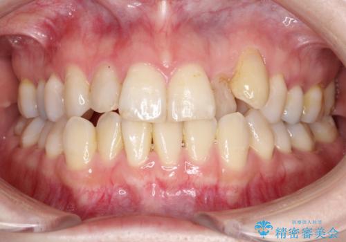 飛び出した八重歯が気になる!非抜歯でマウスピース(インビザライン)による治療症例