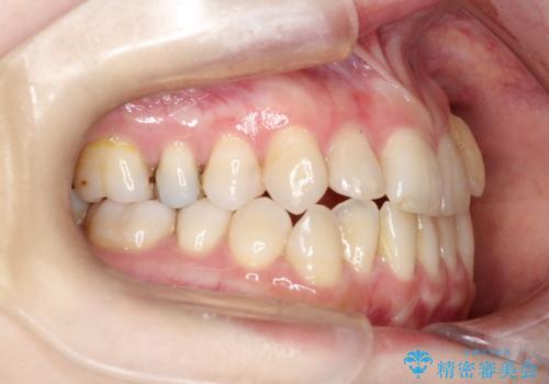 飛び出した八重歯が気になる!非抜歯でマウスピース(インビザライン)による治療症例の治療前