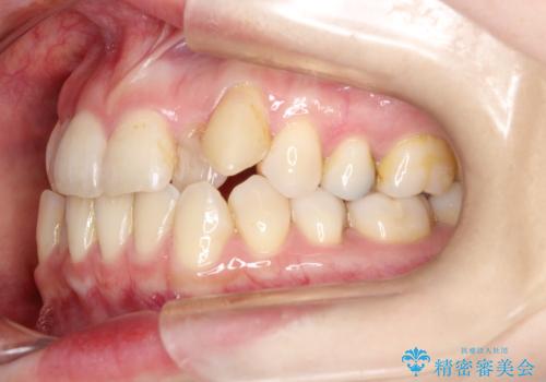 飛び出した八重歯が気になる!非抜歯でマウスピース(インビザライン)による治療症例の治療前