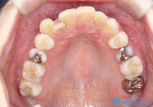 飛び出した八重歯が気になる!非抜歯でマウスピース(インビザライン)による治療症例の治療前