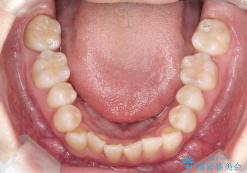 飛び出した八重歯が気になる!非抜歯でマウスピース(インビザライン)による治療症例の治療前