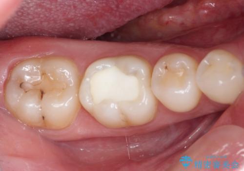 むし歯治療した歯にセラミックを入れたい セラミックインレー修復の治療前