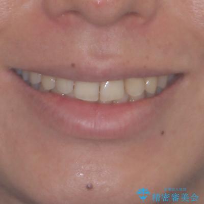 前歯のデコボコをスッキリ改善　インビザライン矯正の治療後（顔貌）