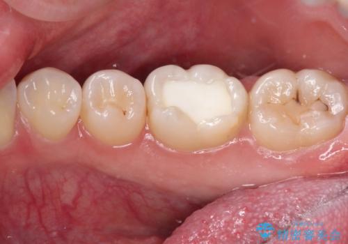 むし歯治療した歯にセラミックを入れたい セラミックインレー修復の治療前