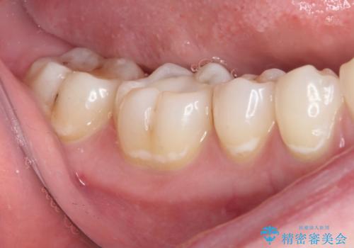 むし歯治療した歯にセラミックを入れたい セラミックインレー修復の治療前