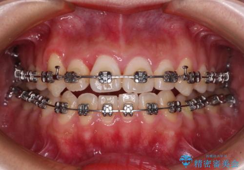 急速拡大装置 狭い上顎骨を拡大してワイヤー装置で短期間治療の治療中