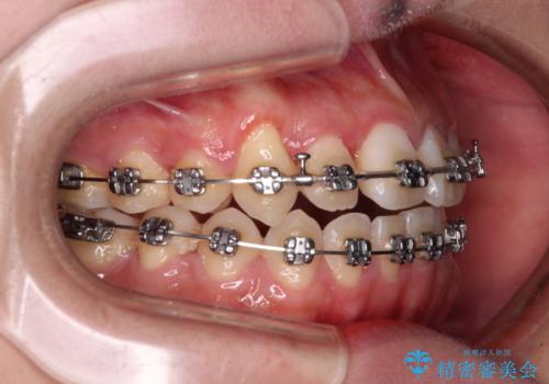 急速拡大装置 狭い上顎骨を拡大してワイヤー装置で短期間治療の治療中