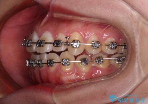 急速拡大装置 狭い上顎骨を拡大してワイヤー装置で短期間治療の治療中