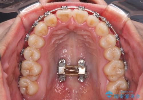 急速拡大装置 狭い上顎骨を拡大してワイヤー装置で短期間治療の治療中