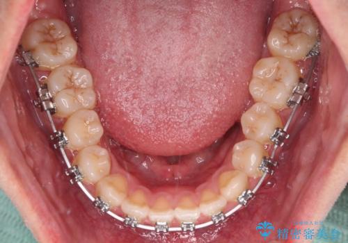 急速拡大装置 狭い上顎骨を拡大してワイヤー装置で短期間治療の治療中