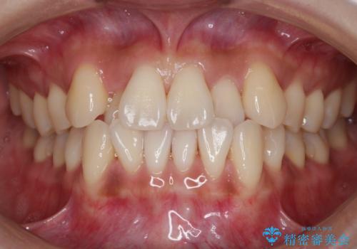 【非抜歯】左右の八重歯・前歯の反対咬合の改善 インビザラインの症例 治療前