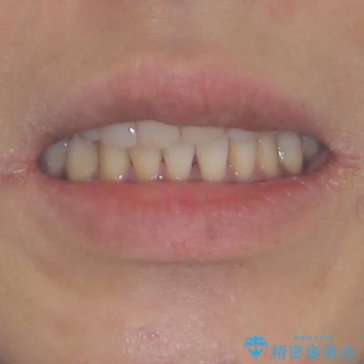 インビザラインでのんびりと矯正治療 の治療後(顔貌)