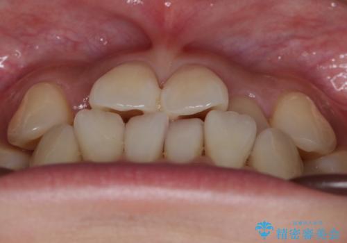 【非抜歯】左右の八重歯・前歯の反対咬合の改善 インビザラインの治療前