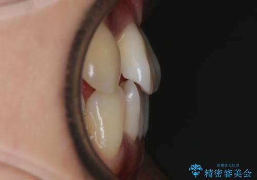 【非抜歯】左右の八重歯・前歯の反対咬合の改善 インビザラインの治療前