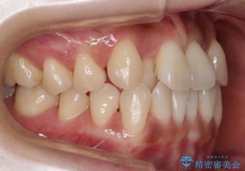 【非抜歯】左右の八重歯・前歯の反対咬合の改善 インビザラインの治療前