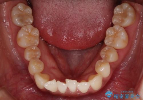 【非抜歯】左右の八重歯・前歯の反対咬合の改善 インビザラインの治療前