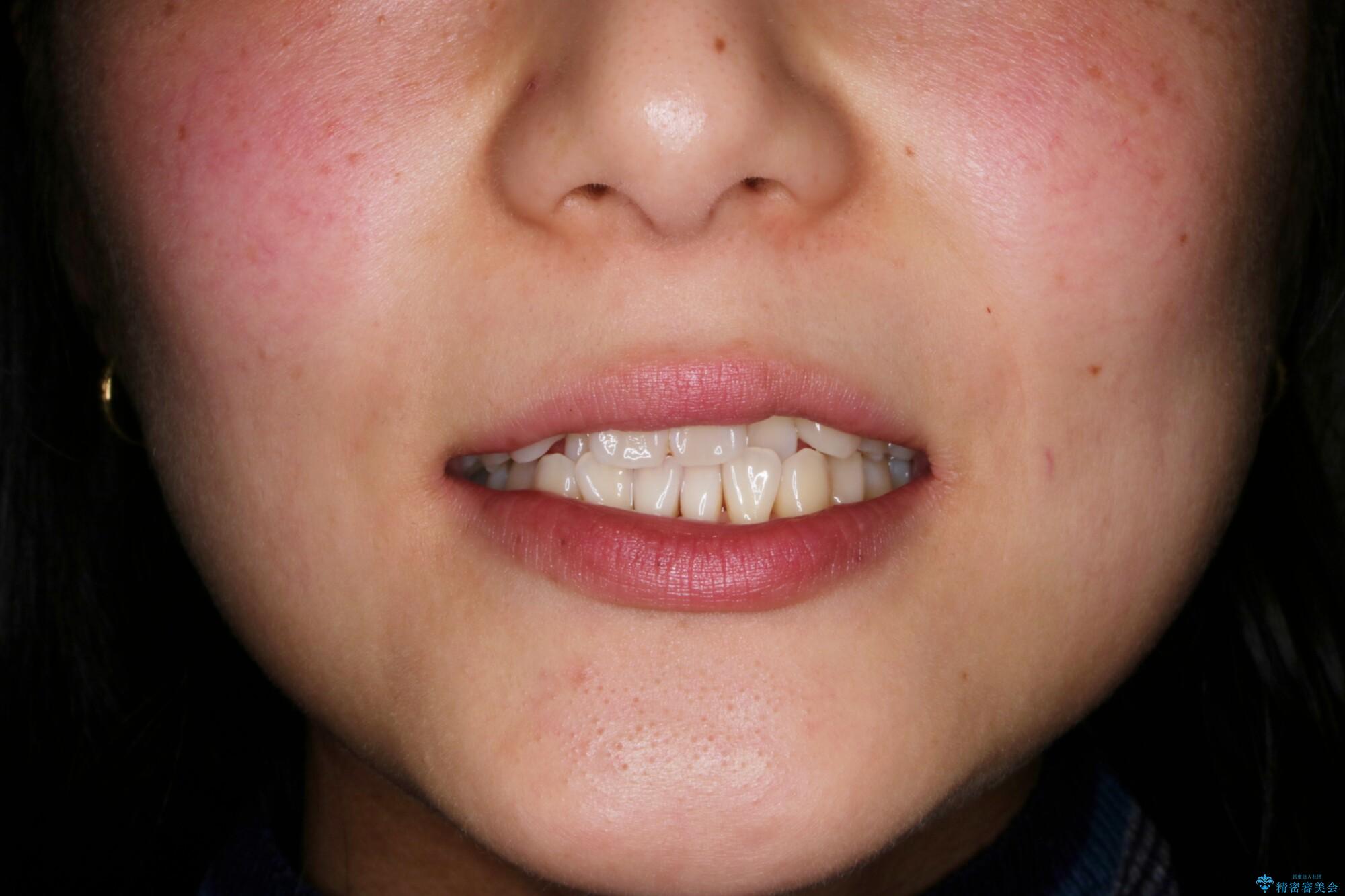 【非抜歯】左右の八重歯・前歯の反対咬合の改善 インビザラインの治療前(顔貌)